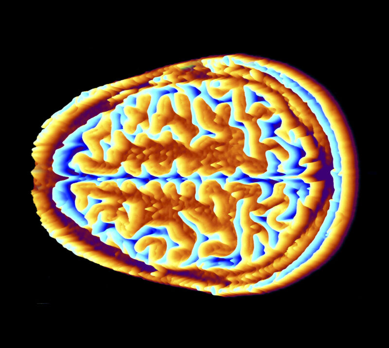 Colored image of a cross section of the skull and brain.